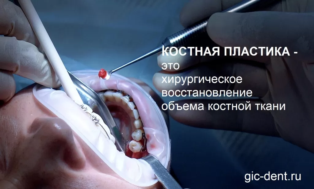 Что такое костная пластика - отвечает хирург-имплантолог НИЦ Дахкильгов Магомед Уматгиреевич